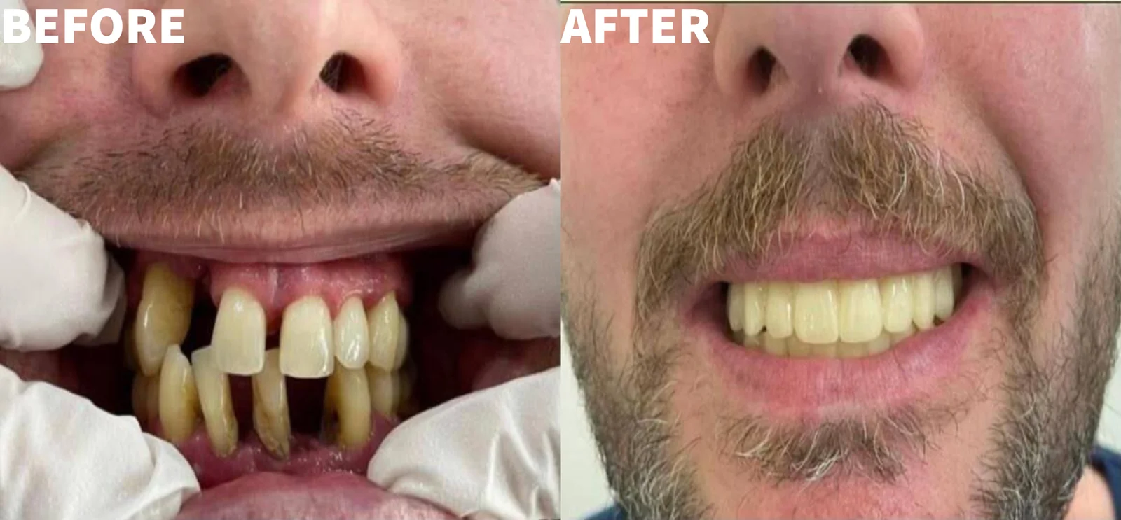 Before and after photo of drifted, loose front teeth replaced with a fixed upper arch