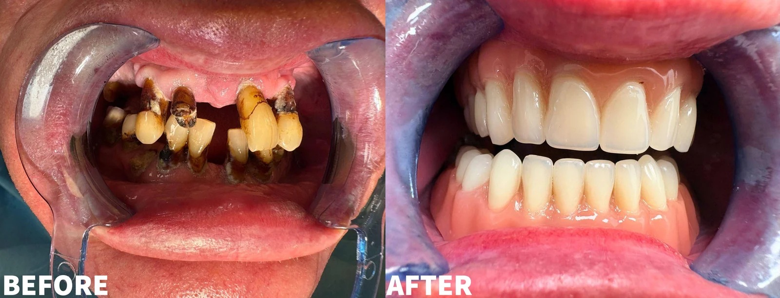 Before and after photo of a full mouth rehabilitation, upper and lower