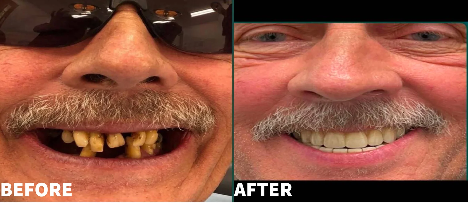 Before and after photo of a full upper arch implant restoration